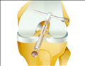 ACL Reconstruction Systems
